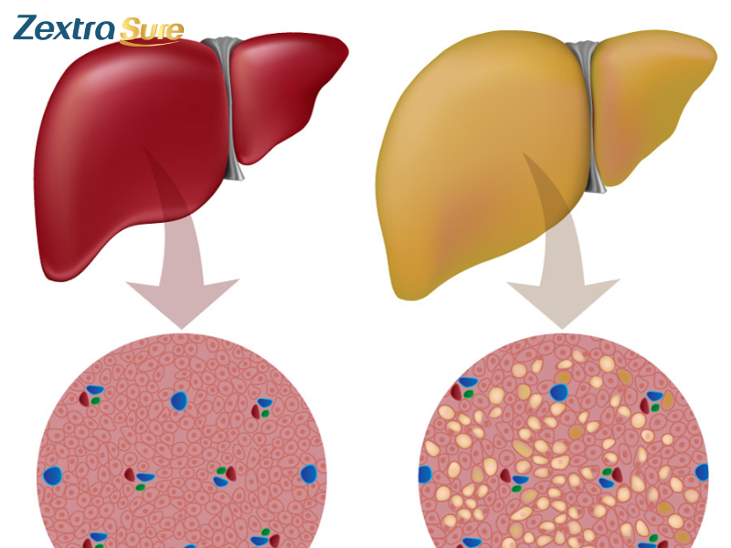 fatty-liver-disease-symptoms-treatment (2)